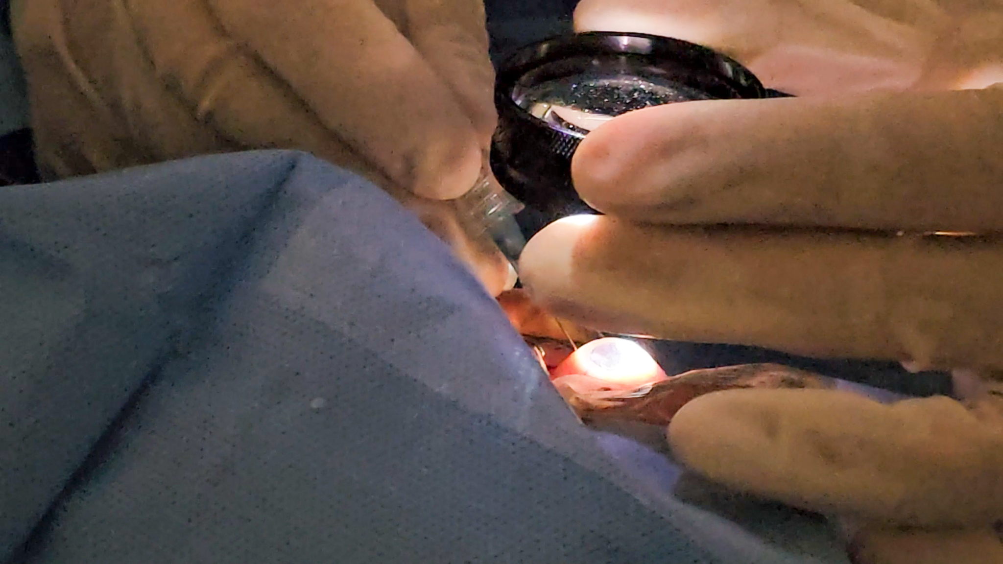 Hospital de Amor inaugura primeiro “Centro de Tratamento de Melanoma Uveal” do SUS, com braquiterapia ocular de alta tecnologia e análise molecular